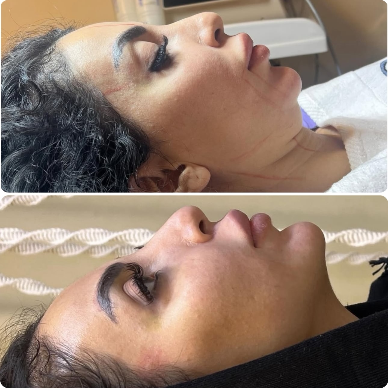 بهترین مرکز هایفوتراپی 1 IMG 4015 2 min