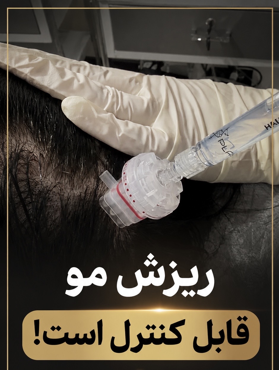 درمان ریزش مو